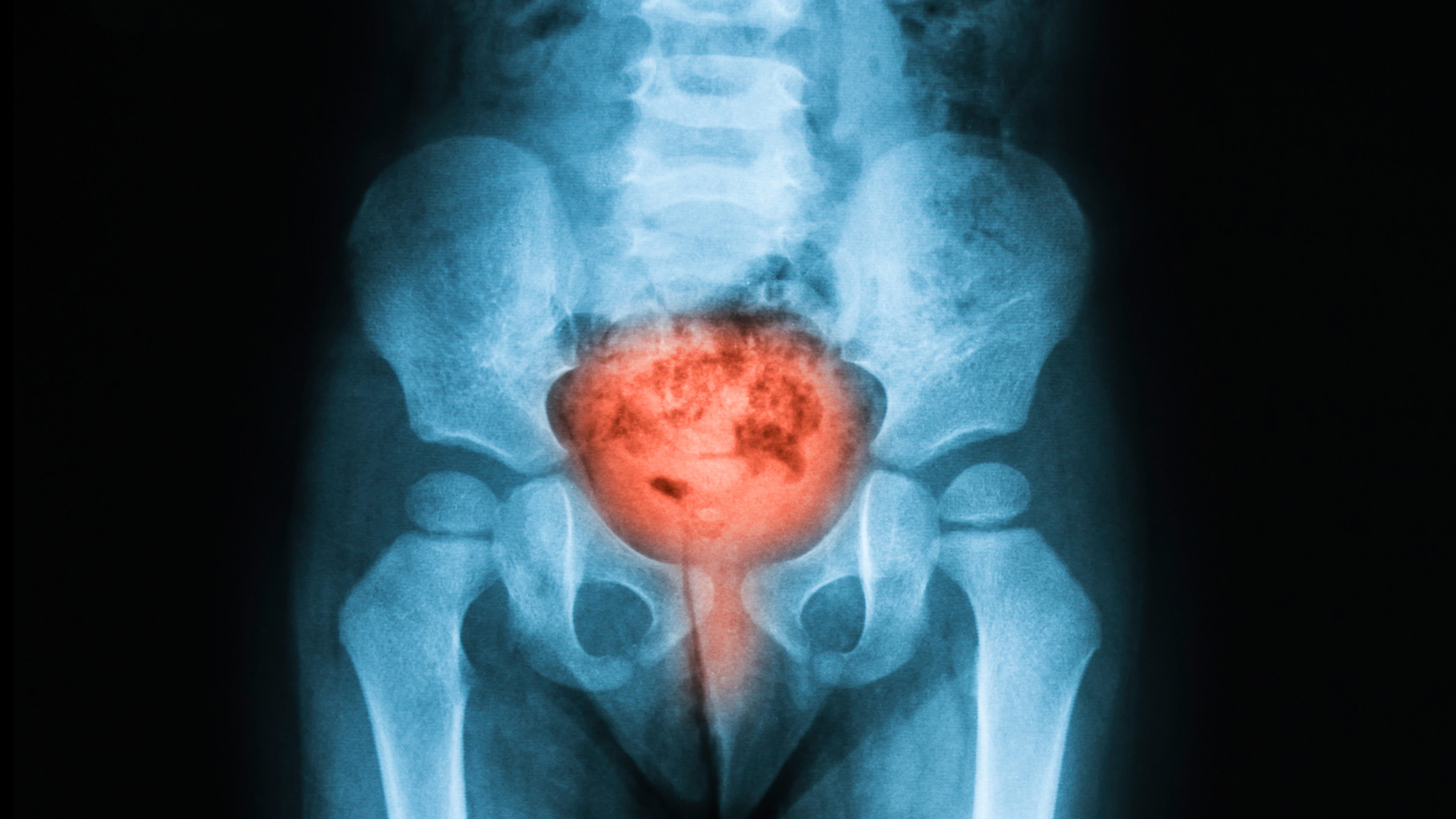 Bladder Cancer