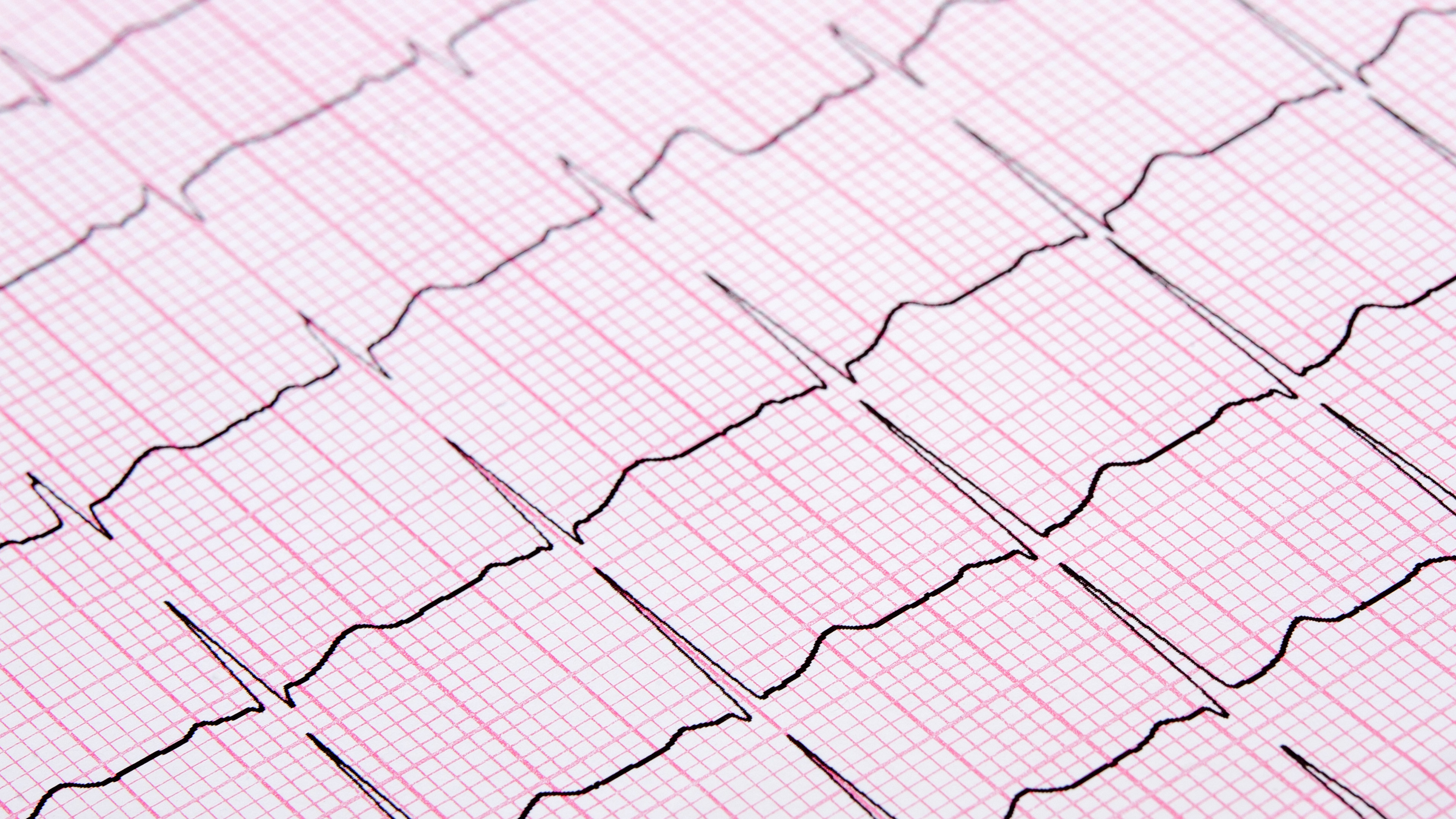 Stress Echocardiogram