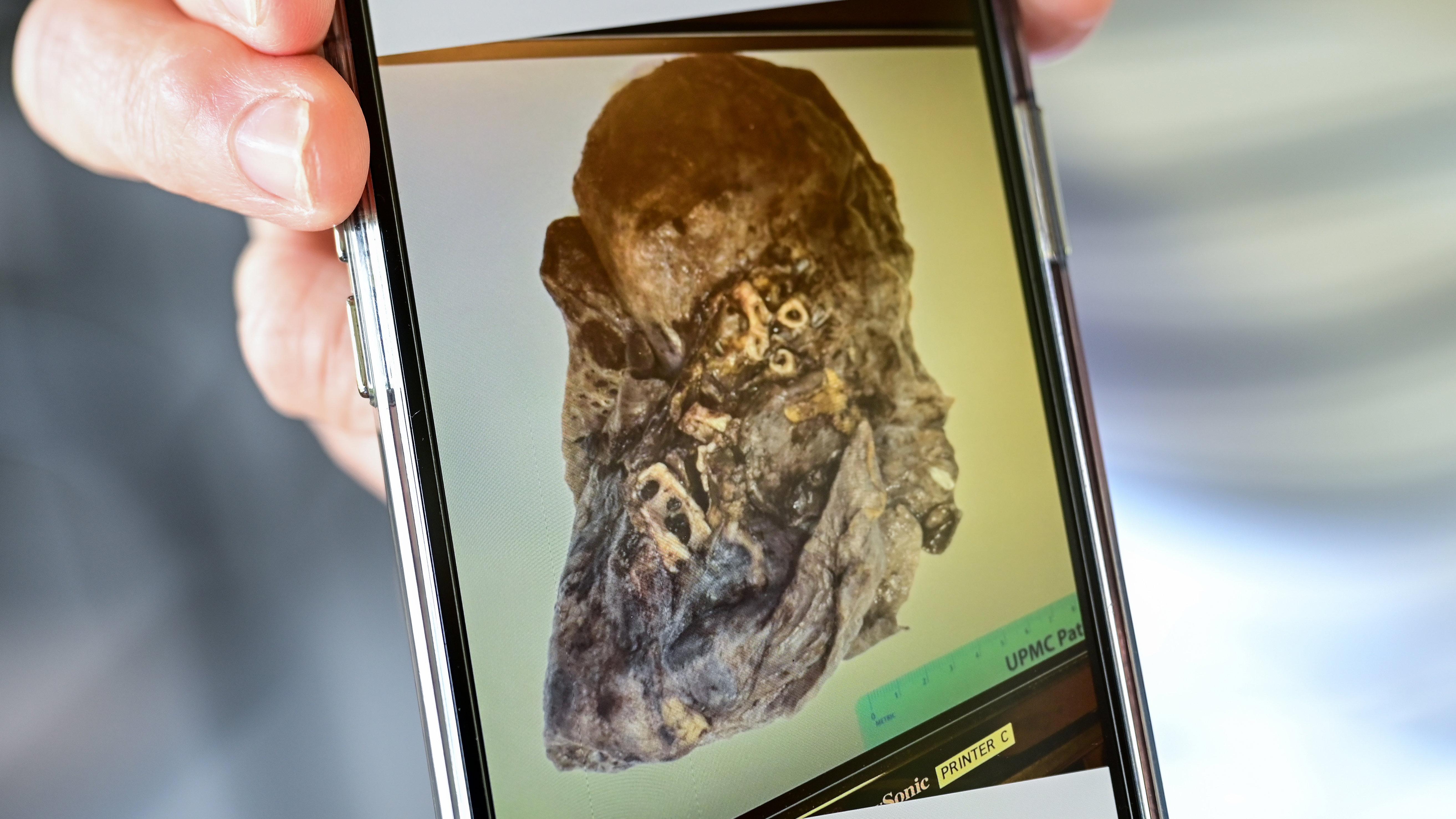 The pulmonary fibrosis, had turned Terry Riddle's own lungs brittle and black.