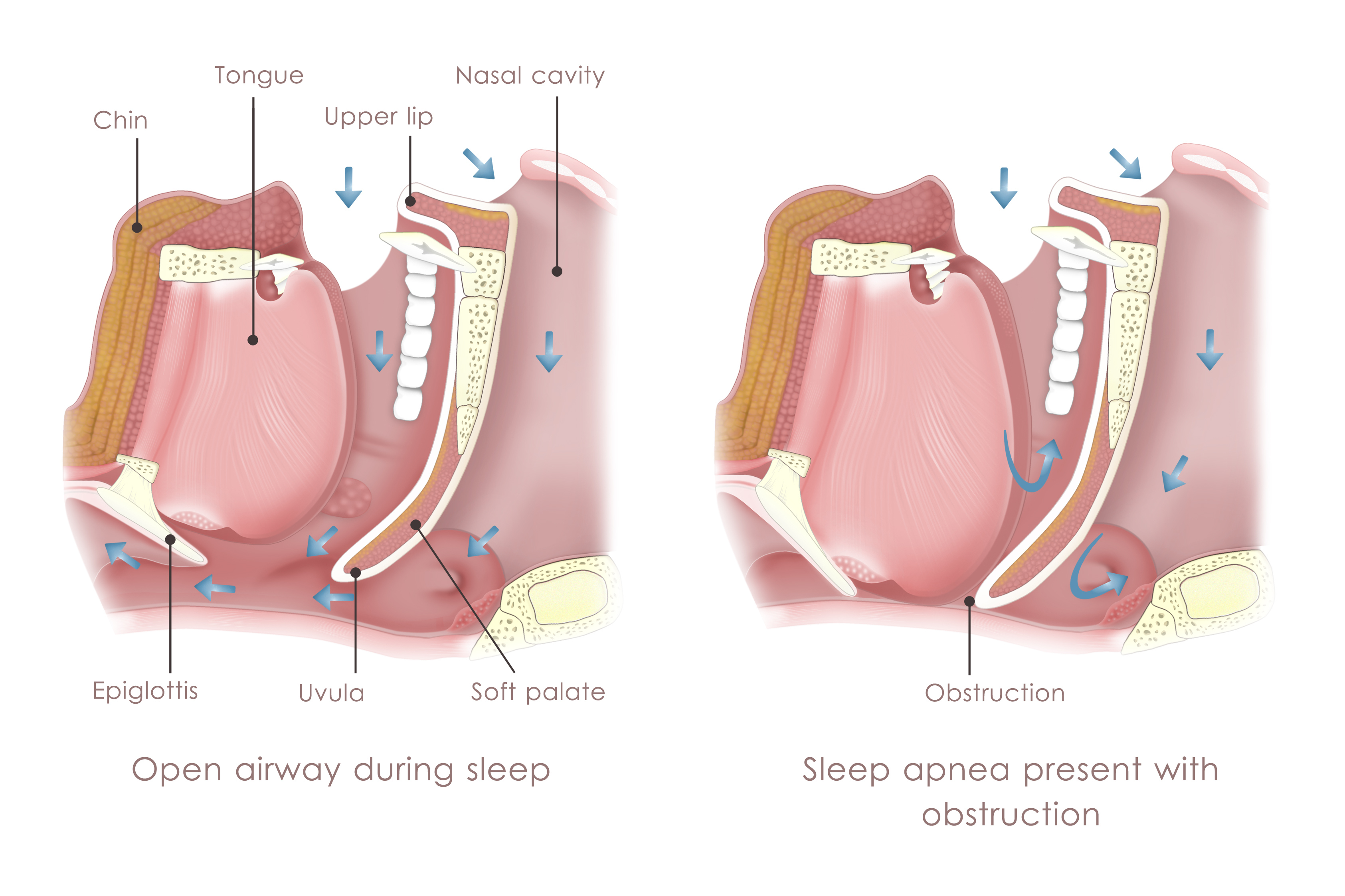 A diagram illustrating Obstruction Sleep Apnea (OSA).