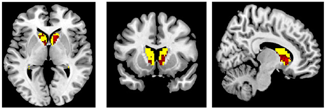 Brain activity in the bilateral caudate region (in red) associated with eye scanning as pilots fly a simulated ILS approach. Image published by PLOS ONE (open source).