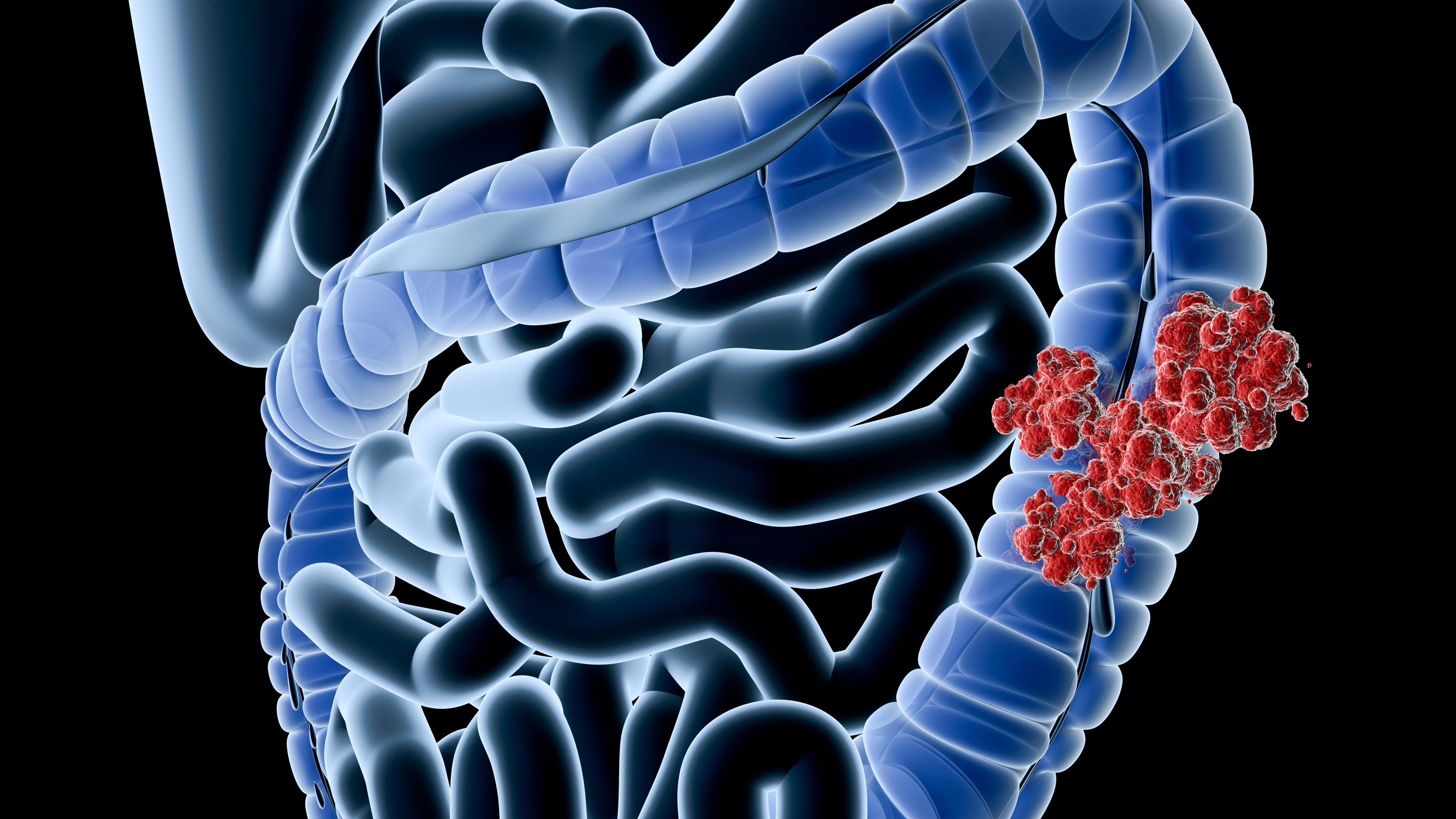 colon cancer colon cancer